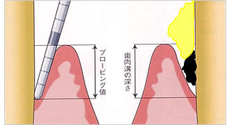 画像：プラークコントロール